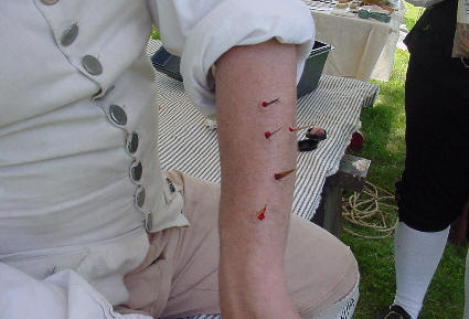 Soldier receiving treatment from wood fragments